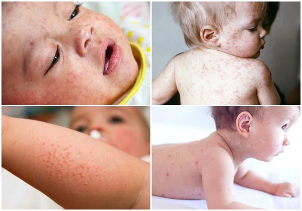 dau-hieu-benh-soi-o-tre-de-nhan-biet-va-cac-cach-dieu-tri-hieu-qua